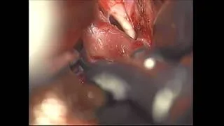 Brain Aneurysm (Posterior Communicating Artery)