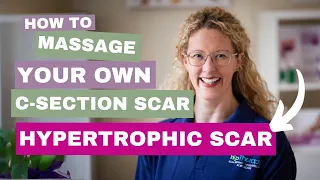 Scar Therapy | Techniques - Hypertrophic Scars | C-Section Scarring and Recovery with HLP Therapy