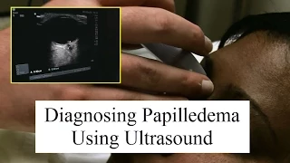 Using Ultrasound to Diagnose Papilledema