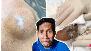 Cyst Popping Bro!!!!!!!