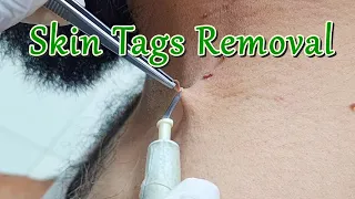How to Remove Skin Tags around Neck with Electric Cautery | Skin Tag Removal Procedure
