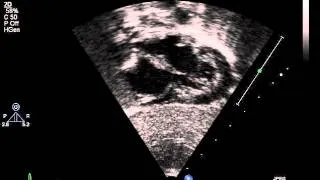 subcostal 4 chamber view (2D)