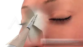 Video Endoscopic Micro Rhinoplasty Dr. Yakup Avsar