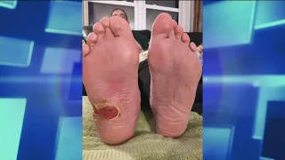 How Diabetic Foot Ulcers Occur