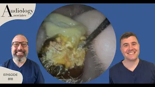 EAR WAX REMOVAL COMPILATION INC TYMPANIC MEMBRANE RETRACTION POCKETS- EP818