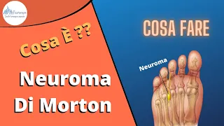 Neuroma di Morton cosa è, come si cura