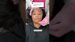 ENTIRE 7 Day chemical peel shedding process for hyperpigmentation on brown skin‼️🫶🏽 #chemicalpeel