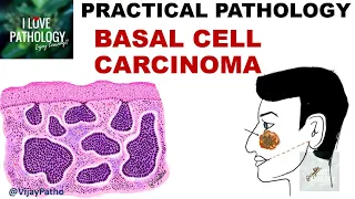 BASAL CELL CARCINOMA: Clinical features & Morphology