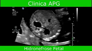 Ultrassonografia Hidronefrose Fetal