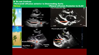 1 Test your skill pericardial vs pleural effusion TR severity