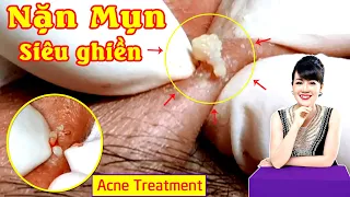 Điều trị mụn hiệu quả tại TPHCM | Hiền Vân spa | Acne treatment | Acne Popping | 607