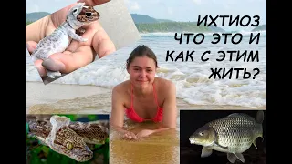 Ихтиоз. Что это такое и как с этим жить?