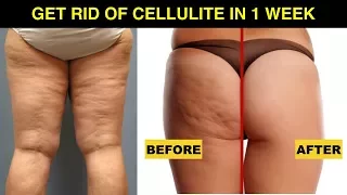 How to get rid of cellulite on thighs and bum fast at home | Just 1 week | 100 % Naturally |