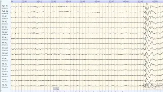 Приступ эпилепсии во время записи ЭЭГ