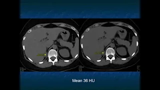 CT of the Large Adrenal Mass: Follow, Biopsy, Resect - Part 1