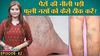 आपके पैरों की नसें फूलकर नीली पड़ रही हैं जानिए क्यों होती हैं | Varicose Veins | Sehat Ep 82