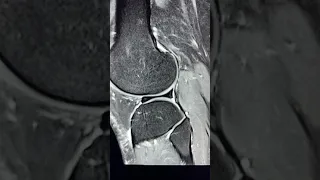 Discoid meniscus - Classic MRI appearance