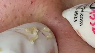 Blackhead removal / Acne treatment /Pimple popping / Cyst popping #000