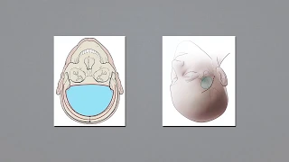 Mini-pterional approach for clip ligation of ethmoidal dural arteriovenous fistula