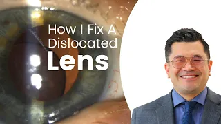 Fixing a Dislocated Lens Implant:  Yamane Technique