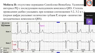 Пак Наталья Лероновна "Нарушения проводимости сердца. ЭКГ" 04.04.2024