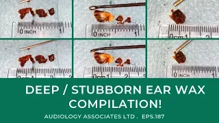 DEEP/STUBBORN EAR WAX REMOVAL COMPILATION! - EP187