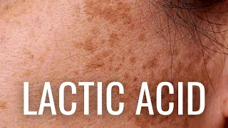 WHY Lactic Acid is Best For Hyperpigmentation