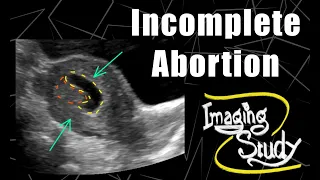 Incomplete Abortion || RPOC || Ultrasound || Case 166