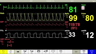 Laerdal monitor