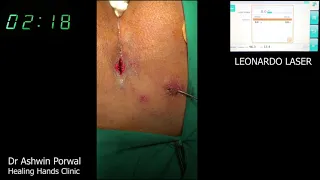 Fastest Unedited Live Laser Surgery For Pilonidal Sinus In 4Min By Dr Porwal At Healing Hands Clinic