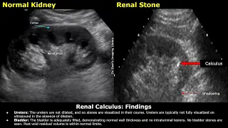 Renal Stone Kidney, Ureter & Bladder (KUB) Ultrasound Report Example | Renal Calculus USG Scan