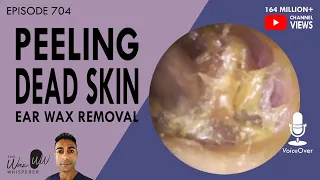 704 - Peeling Dead Skin Ear Wax Removal