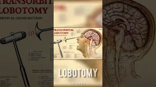 The WORST surgery in history📖|| Lobotomy #shorts