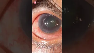 (Q&A) Mắt bị Glôcôm có thể khôi phục lại thị lực sau điều trị hay không?