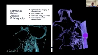 Novel Advanced Imaging & Treatment Paradigms for Patients with IIH and Pulsatile Tinnitus