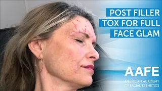 Post Filler Tox for Full Face Glam