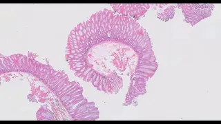 Common epithelial polyps of the colon
