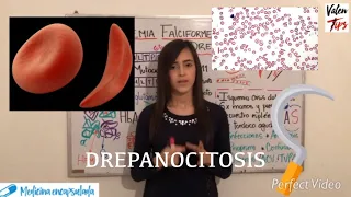 ANEMIA FALCIFORME - DREPANOCITOSIS - HbS💉 ¿rasgo drepanocítico? ¿Protección contra la malaria?👀🔝