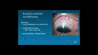 TACROLIMUS TÓPICO EN INFLAMACIÓN OCULAR