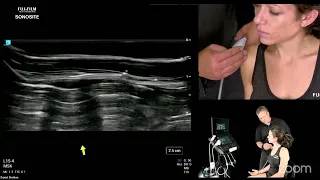 Diagnostic Shoulder Ultrasound: Part 1 - Anterior Shoulder