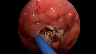 Adenoidectomy