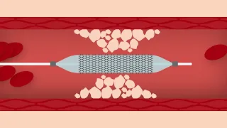 Heart Stent Procedure