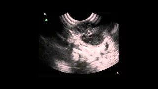 Peritonsillar abscess, drained w direct US guidance