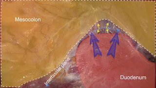 Laparoscopic Rt Hemicolectomy & Extended D3 Lymph Node Dissection with Specimen Extraction