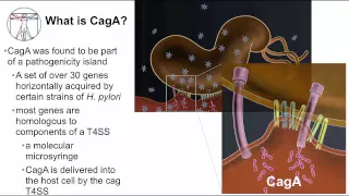 Gastritis: H. pylori cancer pathogenesis