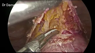 Bladder dissection in Post-Menopausal Uterus