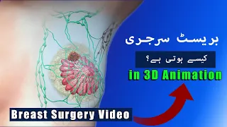 Breast Cancer Surgery In 3D Animation