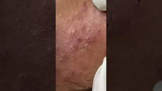 Blackhead 004