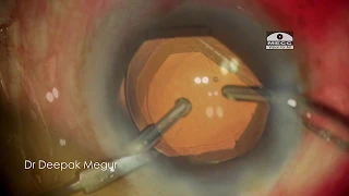 Intra Operative  Miosis , B Hex ring to the rescue