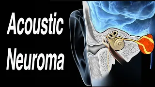 Acoustic Neuroma Causing One Sided Hearing Loss